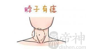 脖子有痣好不好，不同部位有什么代表意思