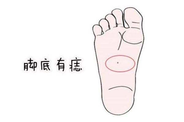 脚底有一颗痣命运好吗？