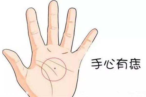 掌心痣代表什么意思