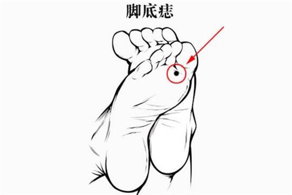 脚底有痣代表了什么