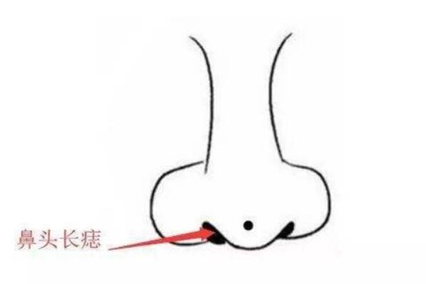 面相鼻子头长痣好不好？